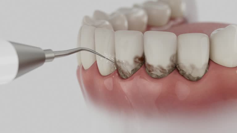 Trusted Dental Crowns And Bridges service in Springfield, VA - Dentist Open Now